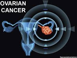 Symptoms typically occur in advanced stages when tumor growth creates pressure on the bladder and rectum, and fluid begins to form. Health Signs Symptoms Of Ovarian Cancer That Women Shouldn T Ignore