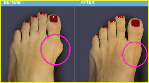 Maybe you would like to learn more about one of these? Bunion Pain 10 Ways To Relieve The Pain Of Bunions Youtube