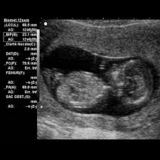 So geht es dem baby. á 12 Ssw Schwangerschaftswoche Alle Infos Grosse Entwicklung