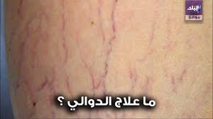 تشمل الآثار الجانبية الشائعة لمثبطات استرداد السيروتونين. ØµØ¯Ù‰ Ø§Ù„Ø¨Ù„Ø¯ Ø£ÙØ¶Ù„ Ø·Ø±Ù‚ Ù„Ø¹Ù„Ø§Ø¬ Ø§Ù„Ø¯ÙˆØ§Ù„ÙŠ ÙˆÙ…Ø§ Ø£Ø³Ø¨Ø§Ø¨ Ø§Ù„Ø¥ØµØ§Ø¨Ø© Ø¨Ù‡Ø§ Youtube