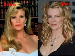 Kim Basinger Plastic Surgery Before And After Plastic Surgery Cosmetic Surgery Surgery