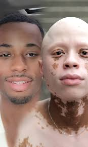 My medication gave me 'vitiligo' 😔