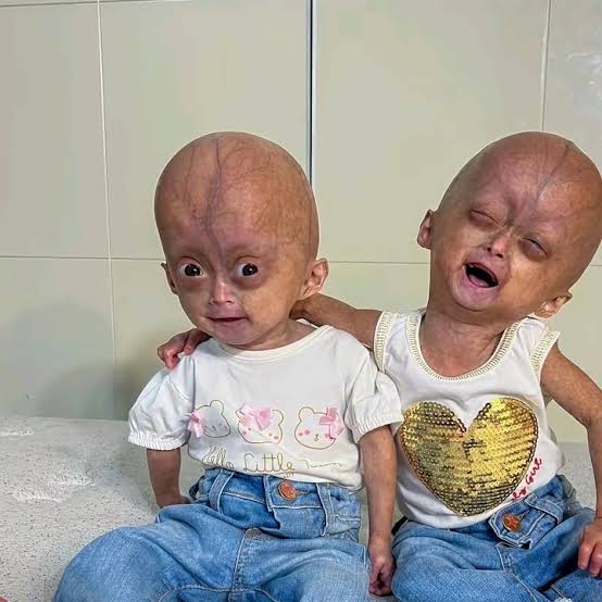 progeria #eliseeloa #elis #eloa #mom | TikTok