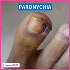 Image result for Paronychia feet