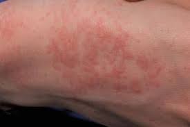 Image result for sweat rash on back baby