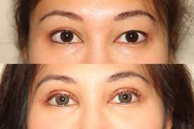 Check spelling or type a new query. Asian Eyelid Surgery Creating A Double Eyelid