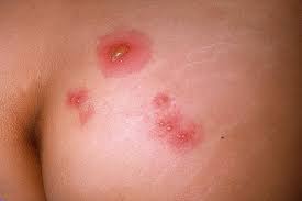 Image result for gonorrhea symptoms