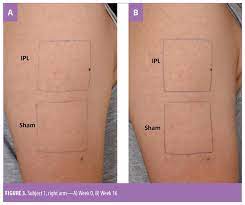 I can't imagine getting laser hair removal anywhere else! Intense Pulsed Light Therapy Significantly Improves Keratosis Pilaris A Randomized Double Blind Sham Irradiation Controlled Trial Jcad The Journal Of Clinical And Aesthetic Dermatology