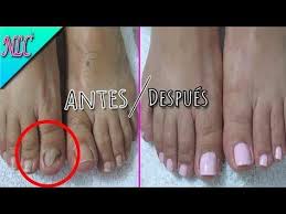 Una biopsia confirmó la infección y el hijo recurrió a las redes sociales para conseguir antifúngicos, hasta ahora sin resultado. Como Arreglar Una Con Hongo Paso A Paso How To Pedicure Nlc Youtube Hongos En Las Unas Hongos Pies Una Hongo