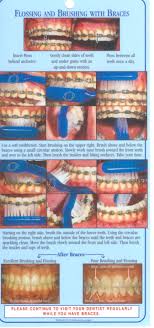 Use floss threader (available at drug store) to feed floss daily under the wire. Pin On Toofies