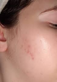 I had pretty bad acne scars after years of horrible acne. How Do I Get Rid Of This Post Acne Scarring Possible Pie Acne