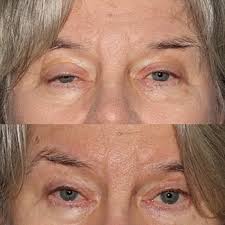 Bilateral Blepharoplasty and External Levator Ptosis Repair