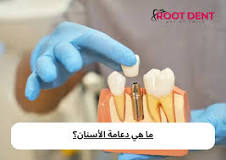 ‫ما أهمية دعامة الأسنان؟ ما هي دعامة الأسنان؟‬‎