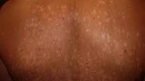Image result for Postinflammatory Hypopigmentation