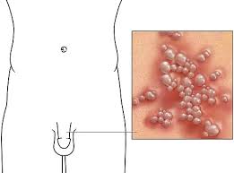 Image result for penis mycosis symptoms