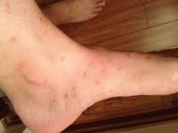 Image result for flea bites
