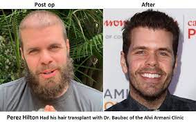 Known by the clinical term. Celebrity Hair Transplants Beverly Hills Celebrity Doctor Los Angeles Alvi Armani