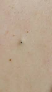 Die harte kern ist ein fernsehfilm aus der krimireihe tatort. Occasion Voiture Achat Verstopfte Talgdruse Pickel Mit Hartem Kern Furunkel Ursachen Symptome Diagnose Behandlung Die Leukoplakie Weisse Flecken Mundschleimhaut