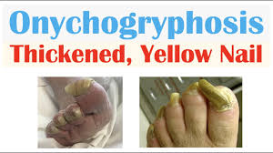 Image result for Onychogryphosis feet