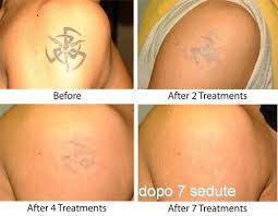 Not only is there pain and a lot of cost after the treatments a lot of times i get blistering and have to be careful about. 65 Laseraway Tattoo Removal Cost