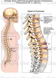 The signs and symptoms of spinal compression fractures can come on gradually and vary from person to person. Female Torso With Post Accident Spinal Compression Fractures To T8 L1 And L2 Medical Illustration Human Anatomy Drawing Anatomy Illustration