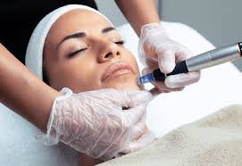 Microneedling