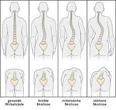 Skoliose Im Jugendalter Gesundheitsinformation De