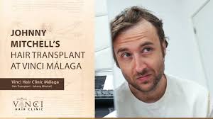 Transforming Locks and Laughter: Johnny Mitchell's Hair Transplant Journey  at Vinci Malaga, Spain