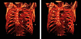The heart is located under the rib cage, to the left of your breastbone (sternum) and between your. Rib Cage Wikipedia