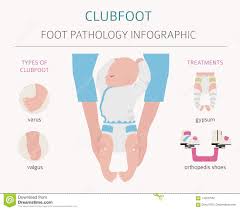 The affected foot appears to have been rotated internally at the ankle. Clubfoot Stock Illustrationen Vektoren Kliparts 37 Stock Illustrationen