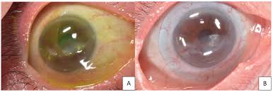 Image result for lesion sclera