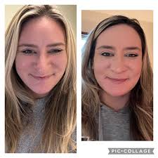 Officially four weeks post op from my septoplasty, rhinoplasty and  turbinate reduction!!! The swelling will continue to come down, it  typically takes 9-12 months to do so, but I'm already so thrilled