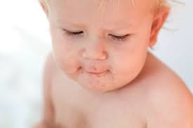 Image result for dermatitis contacta children