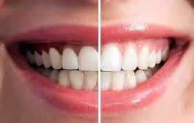 Gum Depigmentation