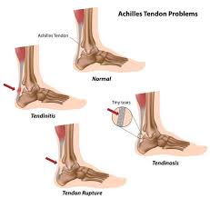 The Difference Between Tendonitis And Tendonosis And Why It Matters