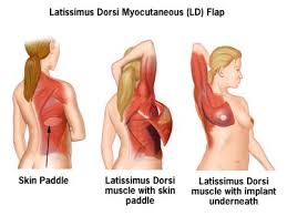 Pin On Breast Reconstruction Resources