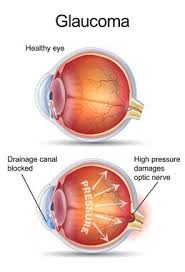 Any of a group of eye diseases characterized by abnormally high intraocular fluid pressure, damaged optic disk, hardening of the eyeball. Glaucoma The Optometry Group