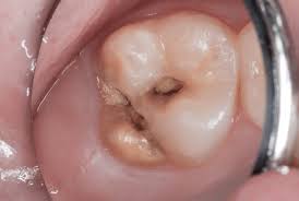 Enamel hypoplasia is a defect in the enamel due to disturbance of ameloblastic function during amelogenesis. Treatment Options For Hypoplastic And Hypocalcified Permanent Molars In Children