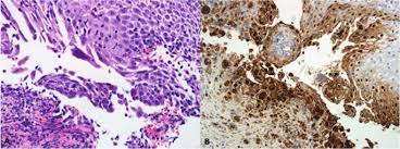 An immunocompromised state, the more commonly seen manifestations are oral candidiasis or hsv or cmv esophagitis. Herpetic Esophagitis In Immunocompentent Host Cases Report Bmc Infectious Diseases Full Text