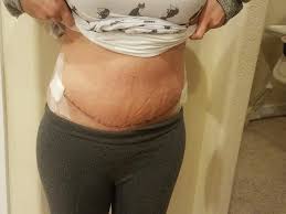 Diastasis Recti Repair Surgery Pt 3 Diastasis Recti Repair Tummy Tucks Recovery Diastasis Recti