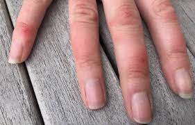 Mais il y a aussi des raisons plus sérieuses pour lesquelles un engourdissement des doigts se produit, une sensation de picotement au bout des doigts. Coronavirus Pseudo Gelures Irritations Aux Mains Et Aux Pieds De Nouveaux Symptomes Du Covid 19
