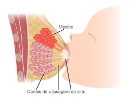 Resultado de imagem para mastite humana