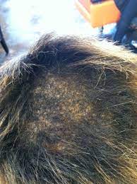 Check spelling or type a new query. My Bald Spot Before Red S Kitchen Sink Hair System Herbal Hair Long Hair Styles