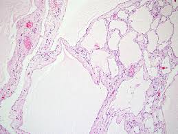 We describe a rare case of bpcm . Benign Multicystic Peritoneal Mesothelioma Wild Country Fine Arts