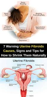 Fibroids also may cause no symptoms at all. Here Are 7 Warning Uterine Fibroids Causes Signs Tips For How To Shrink Them Naturally Way To Steal Health Uterine Fibroids Fibroids Treatment Fibroids