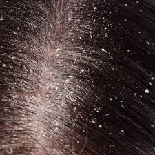 Berikut ini cara menghilangkan iklan di hp android, yaitu dengan adblock, browser anti iklan, settingan google chrome, dan uc browser. 4 Cara Menghilangkan Kelemumur