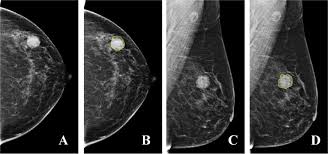 The mammogram and all other tests came back normal. Evaluating The Her 2 Status Of Breast Cancer Using Mammography Radiomics Features European Journal Of Radiology