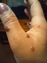 Image result for ant bite