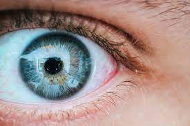 Venas Rojas En Los Ojos Operacion De Ojos