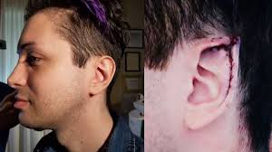 When parents would do anything to have their kids get over hereditary elf and keep in mind, there are not a great deal of body adjustment artists who do this kind of procedure. How Much Does It Cost To Get Elf Ears How